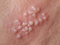 Những thông tin cơ bản về căn bệnh mụn cóc sinh dục – Phòng kiểm tra Hưng Thịnh