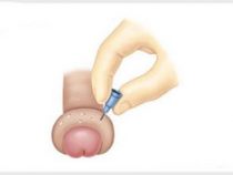 Những tác hại của hẹp bao quy đầu với nam giới – Phòng thăm khám Hưng Thịnh