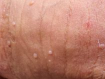 Nổi mụn ở bộ phận sinh dục là bị bệnh gì? – Phòng Khám Hưng Thịnh