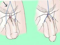 Phương pháp nếu để lâu dương vật nam giới hiện nay – Phòng kiểm tra Hưng Thịnh
