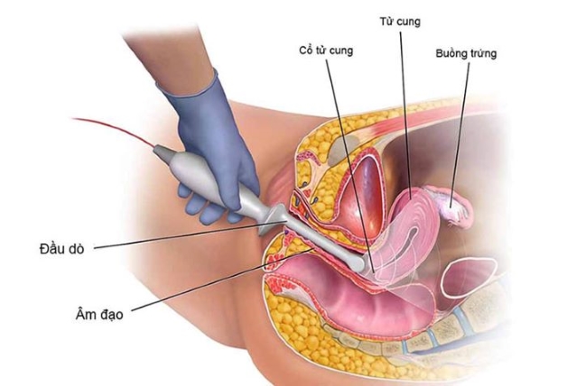 Siêu âm đầu dò