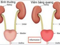 Tác hại của viêm bọng đái với sức khỏe như thế nào? – Phòng thăm khám Hưng Thịnh
