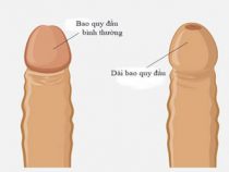 Tìm hiểu chi tiết về chứng dài bao quy đầu – Phòng kiểm tra Hưng Thịnh