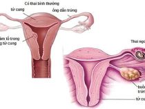 Tìm hiểu chung về căn bệnh viêm buồng trứng thường gặp ở phụ nữ – Phòng xét nghiệm Hưng Thịnh