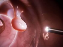 Triệu chứng căn bệnh polyp cổ tử cung nữ giới cần phải biết – Phòng xét nghiệm Hưng Thịnh