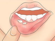 Triệu chứng và cách điều trị herpes sinh dục ở miệng – Phòng Khám Hưng Thịnh