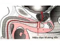 Viêm niệu đạo ở nam giới là như thế nào? – Phòng xét nghiệm Hưng Thịnh