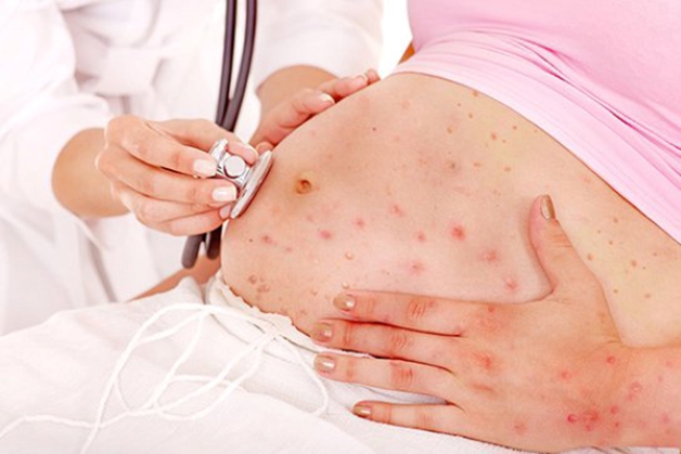 Bệnh rubella ở bà bầu