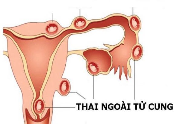 Chửa ngoài dạ con cắt 1 bên buồng trứng có thai được không là thắc mắc của nhiều chị em. Buồng trứng được biết đến là cơ quan với chức năng sinh sản noãn bào và nội tiết tạo ra hormone sinh dục nữ.