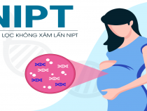 Có nên tiến hành xét nghiệm Nipt thường không?