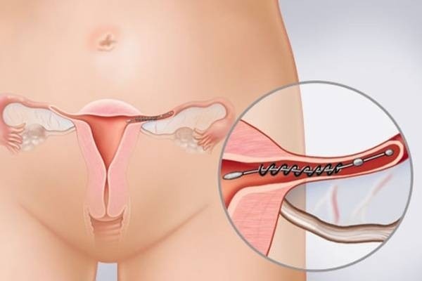 Trên thực tế, sau khi đã triệt sản, chị em rất khó có thể mang thai lại