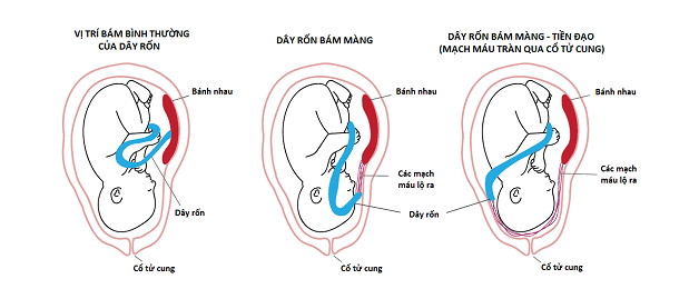 dây rốn bám màng