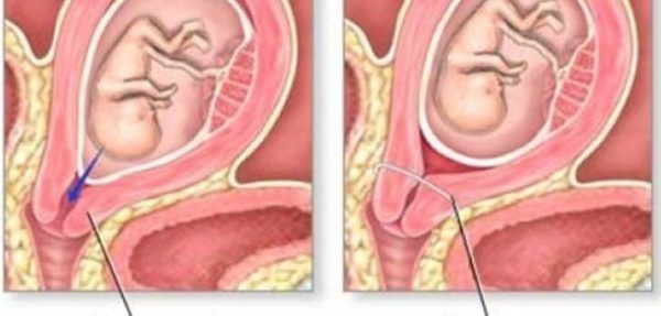 Hở eo tử cung là hiện tượng khi khi mô cổ tử cung mở ra trước hoặc trong quá trình mang thai