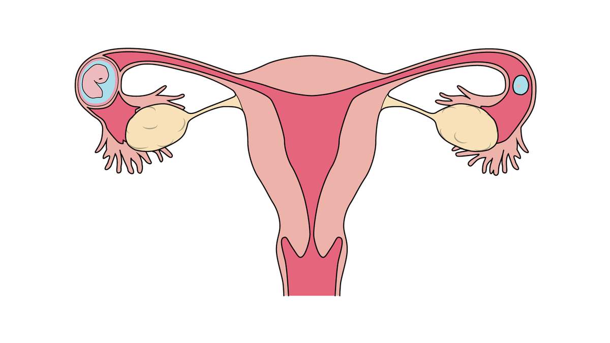 Mang thai ngoài dạ con là hiện tượng thai nhi không làm tổ trong buồng tử cung