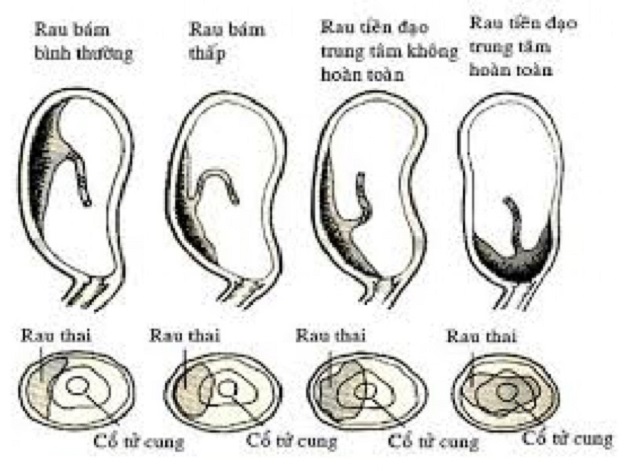 nhau thai bám thấp mặt sau