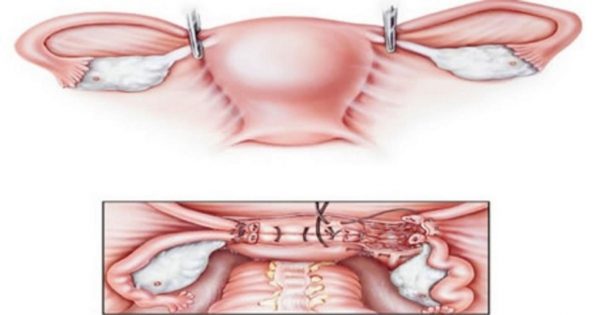 Khi thực hiện cắt bỏ toàn bộ tử cung, nếu không cẩn thận có thể gây tổn thương cho các cơ quan lân cận.