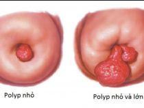 Tư vấn thắc mắc: Polyp cổ tử cung có thai được không?