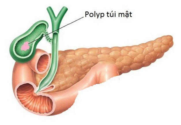 polyp túi mật khi mang thai