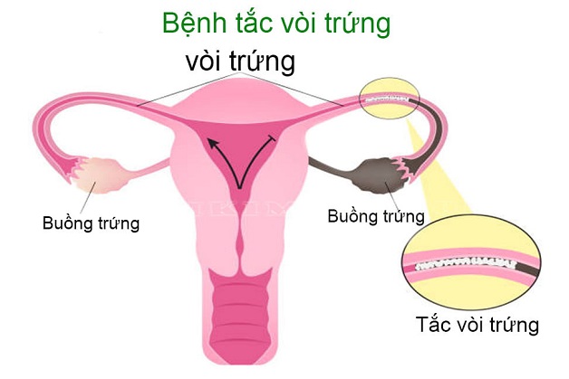 tắc vòi trứng có chữa được không