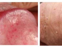 Dương vật gặp phải nổi hột trắng cảnh báo 7 căn bệnh nguy hiểm [ Lưu ý]