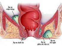 [ PHÂN TÍCH ] Hình ảnh áp xe hậu môn theo từng thời kỳ của chứng bệnh