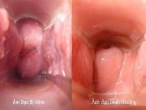 Nhân diện những hình ảnh viêm bộ phận sinh dục nữ chân thực, nhiều chị em gặp phải