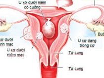 [ Tìm Hiểu ] 7+ dấu hiệu u xơ cổ tư cung dễ nhận biết nhất hiện này