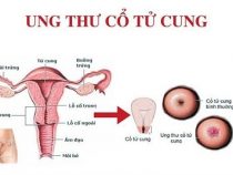 [ Review ] Tiêm u xơ cổ tử cung ở đâu uy tín và giá bao tiền ?