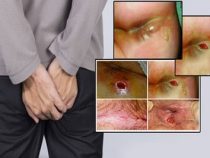 [ Giải Đáp ] Áp-xe hậu môn có nguy hiểm không và phương pháo điều trị an toàn
