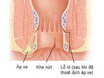 [ Giải Đáp ] Apxe hậu môn uống thuốc gì nhanh khỏi và thời gian bao lâu ?
