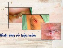chứng bệnh rò hậu môn và cách điều trị tốt nhất – Phòng thăm khám Hưng Thịnh