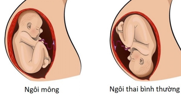 Có thể xác định ngôi thai ngược vào tuần thai thứ 32