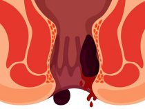 Những triệu chứng của trĩ nội nên đề phòng – Phòng xét nghiệm Hưng Thịnh