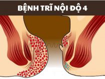 Những điều cần phải biết về trĩ nội độ 4 – Phòng kiểm tra Hưng Thịnh