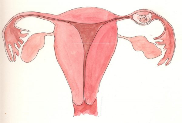 Chửa ngoài tử cung thể huyết tụ thành nang là những trường hợp thai ngoài dạ con bị vỡ, có máu chảy rỉ rả tụ máu lại ở cùng đồ sau
