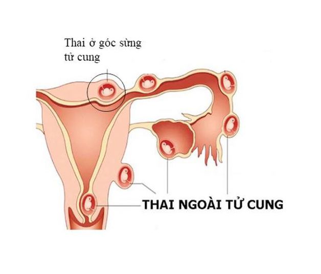 Thai ngoài tử cung là khái niệm dùng để chỉ những trường hợp mà thai không nằm ở trong tử cung mà nằm ở nơi khác, ngoài tử cung.