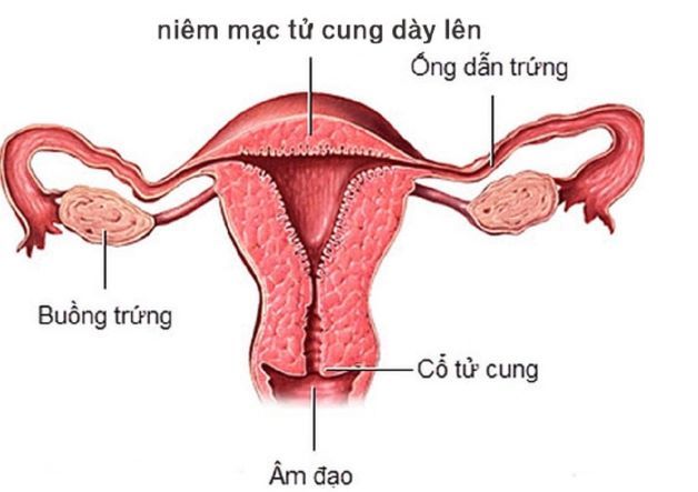 Thai ngoài tử cung niêm mạc dày bao nhiêu là thắc mắc của rất nhiều người. Bởi thai ngoài tử cung có thể gây ra các biến chứng nguy hiểm như: sảy thai, thai chết lưu,