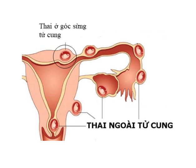 Nếu thủ thuật thực hiện thất bại, nguy cơ chửa ngoài tử cung là rất lớn.