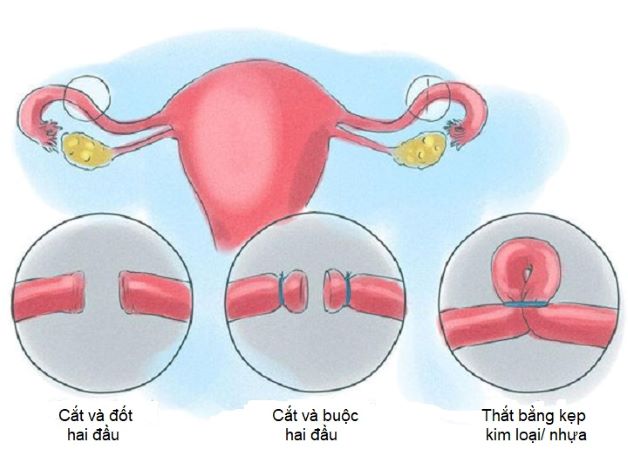 Có nhiều cách để thực hiện thắt ống dẫn trứng triệt sản như buộc, cắt rời, đốt điện, dùng kẹp kim loại hoặc vòng nhựa để thắt lại.