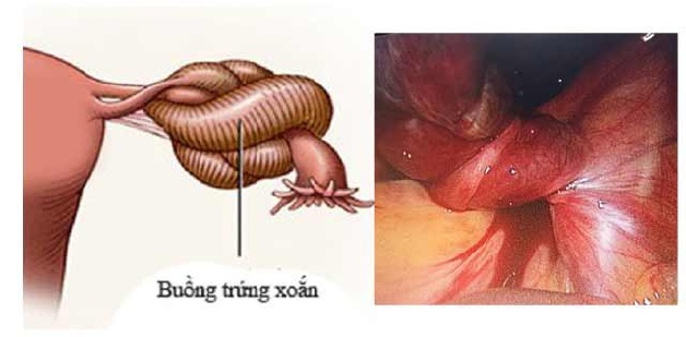 U nang buồng trứng xoắn là gì