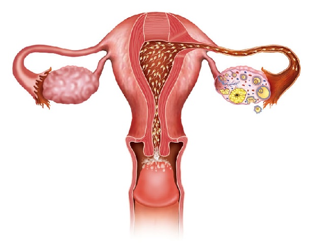 U xơ tử cung có thể xảy ra ở những chị em trong độ tuổi mãn kinh