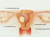 U xơ tử cung dưới niêm mạc là chứng bệnh gì? Có nguy hiểm thường không?