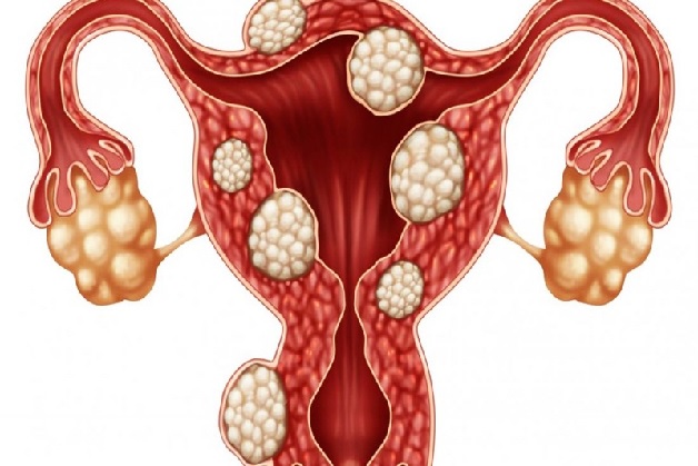U xơ tử cung dưới niêm mạc là căn bệnh thường gặp