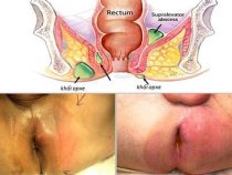 [ CẢNH BÁO ] 10+ hệ lụy áp xe hậu môn gây ra tác động tới người căn bệnh