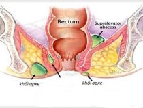 [ Giải Đáp ] Apxe hậu môn khi mang thai có nguy hiểm không và chữa trị ra sao ?