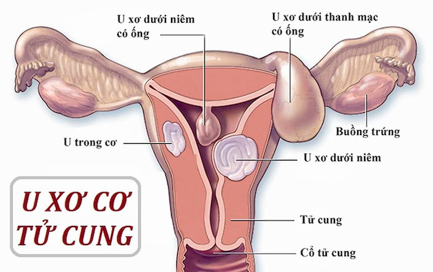 U xơ tử cung là gì có nguy hiểm không?