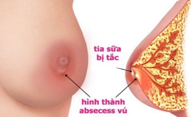 Tắc tia sữa là nguyên nhân phổ biến nhất gây ra tình trạng áp xe vú sau sinh