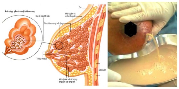 Điều trị áp xe vú bằng cách dẫn lưu hút mủ