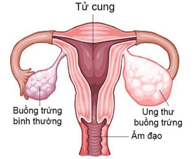 Cắt buồng trứng có thai được không là vấn đề của nhiều người quan tâm, nhất là sau khi thực hiện phẫu thuật buồng trứng