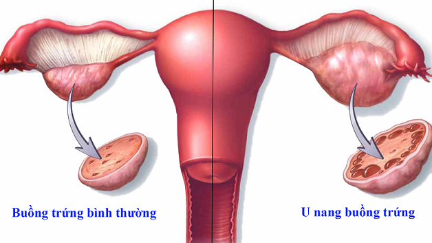 Sau khi bác sĩ thực hiện việc mổ u nang buồng trứng cho bệnh nhân thì khi ấy cơ thể còn rất yếu, chưa thể hoạt động mạnh được